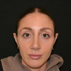 Rhinoplasty Before & After Patient #19715