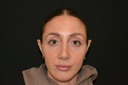 Rhinoplasty Before & After Patient #19715
