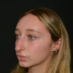 Rhinoplasty Before & After Patient #19764