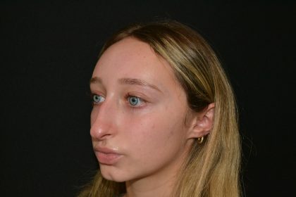 Rhinoplasty Before & After Patient #19764