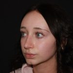 Rhinoplasty Before & After Patient #19764