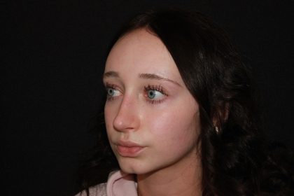 Rhinoplasty Before & After Patient #19764
