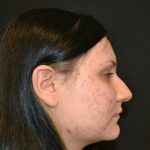 Rhinoplasty Before & After Patient #19712