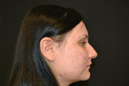 Rhinoplasty Before & After Patient #19712