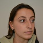 Rhinoplasty Before & After Patient #19711