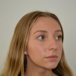 Rhinoplasty Before & After Patient #19713