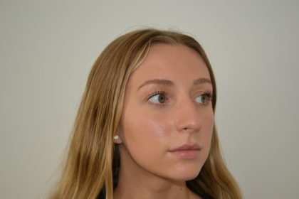 Rhinoplasty Before & After Patient #19713