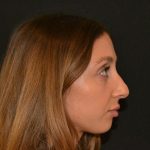 Rhinoplasty Before & After Patient #19715