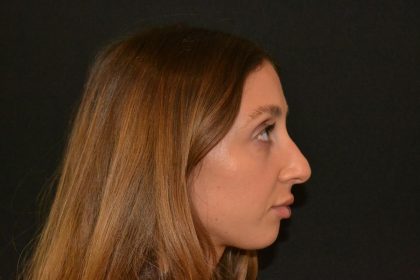 Rhinoplasty Before & After Patient #19715