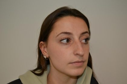 Rhinoplasty Before & After Patient #19711