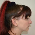 Rhinoplasty Before & After Patient #19716