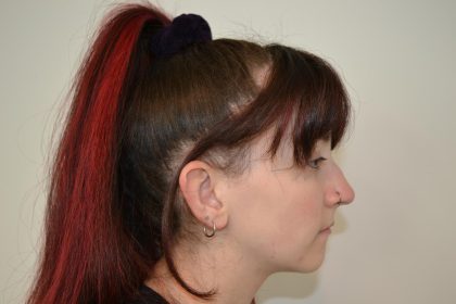Rhinoplasty Before & After Patient #19716