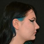Rhinoplasty Before & After Patient #19712