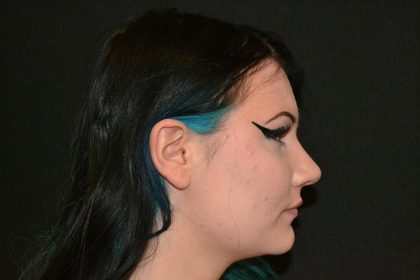 Rhinoplasty Before & After Patient #19712