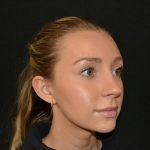 Rhinoplasty Before & After Patient #19713