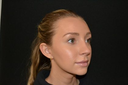 Rhinoplasty Before & After Patient #19713