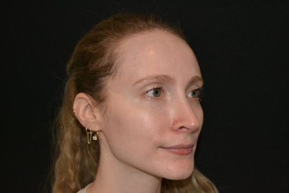 Rhinoplasty Before & After Patient #19714