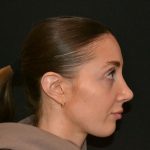 Rhinoplasty Before & After Patient #19715