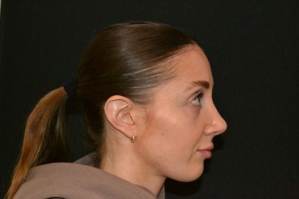 Rhinoplasty Before & After Patient #19715