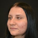 Rhinoplasty Before & After Patient #19712