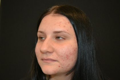 Rhinoplasty Before & After Patient #19712