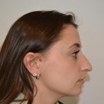 Rhinoplasty Before & After Patient #19711