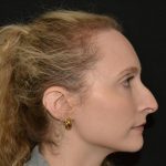 Rhinoplasty Before & After Patient #19714