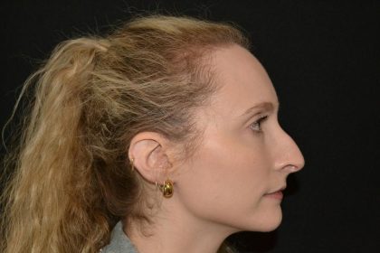 Rhinoplasty Before & After Patient #19714