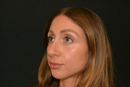Rhinoplasty Before & After Patient #19715