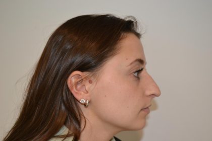 Rhinoplasty Before & After Patient #19711