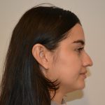 Rhinoplasty Before & After Patient #19717