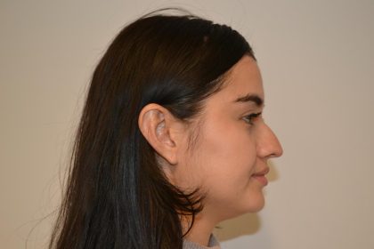 Rhinoplasty Before & After Patient #19717