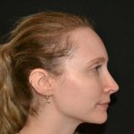 Rhinoplasty Before & After Patient #19714