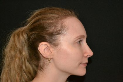 Rhinoplasty Before & After Patient #19714