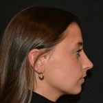 Rhinoplasty Before & After Patient #19711