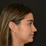 Rhinoplasty Before & After Patient #19717