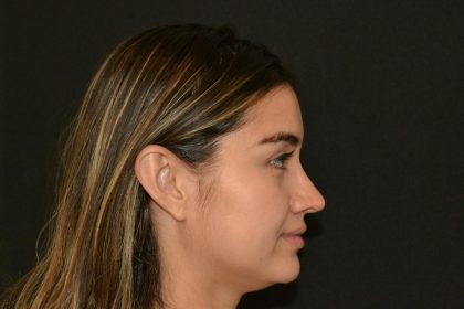 Rhinoplasty Before & After Patient #19717