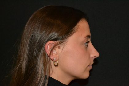 Rhinoplasty Before & After Patient #19711