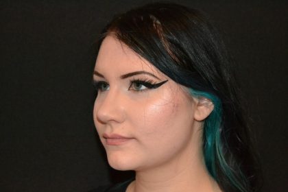 Rhinoplasty Before & After Patient #19712