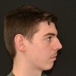 Rhinoplasty Before & After Patient #19840