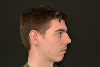 Rhinoplasty Before & After Patient #19840