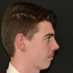 Rhinoplasty Before & After Patient #19840
