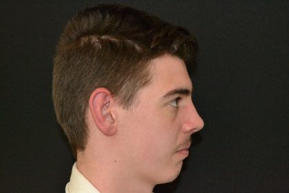 Rhinoplasty Before & After Patient #19840