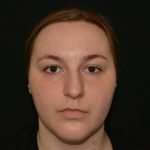 Rhinoplasty Before & After Patient #19847