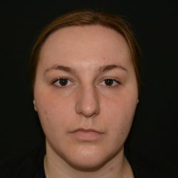 Rhinoplasty Before & After Patient #19847