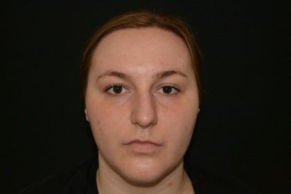 Rhinoplasty Before & After Patient #19847