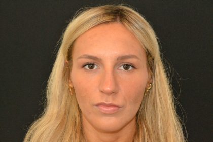 Rhinoplasty Before & After Patient #19847
