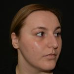 Rhinoplasty Before & After Patient #19847