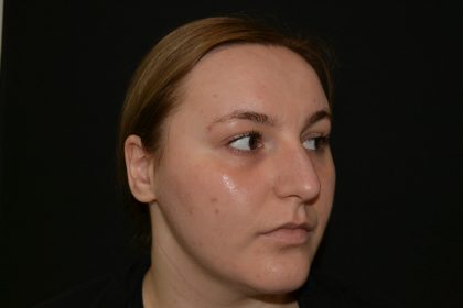 Rhinoplasty Before & After Patient #19847
