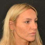 Rhinoplasty Before & After Patient #19847
